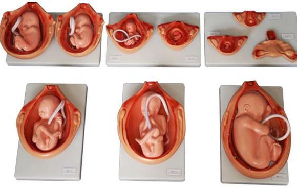 如何避免试管婴儿III期的胎儿流产？